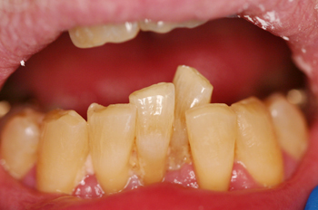 Crowns